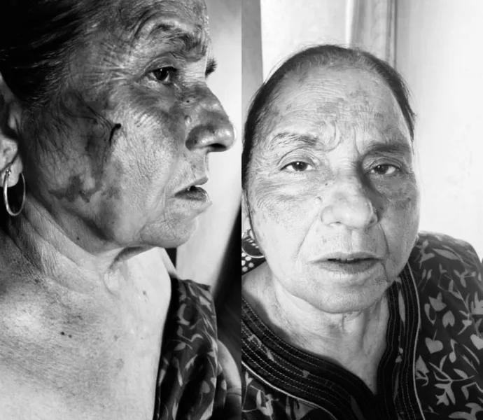 आदित्यपुर में मकान खाली कराने पर किराएदार ने गृहस्वामी पर फेंकी खौलती दाल